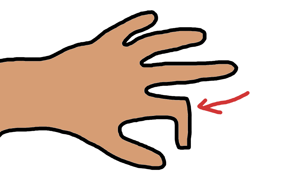 Have you been in an accident that wasn't your fault? A finger has a 90 degree sideways bend in it